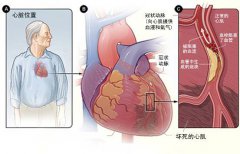 冠心病的起因是什么？