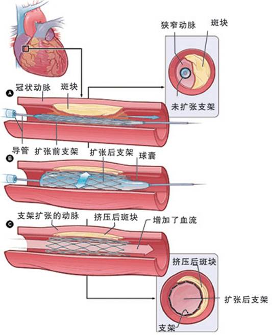 怎樣治療冠心?。?圖2)