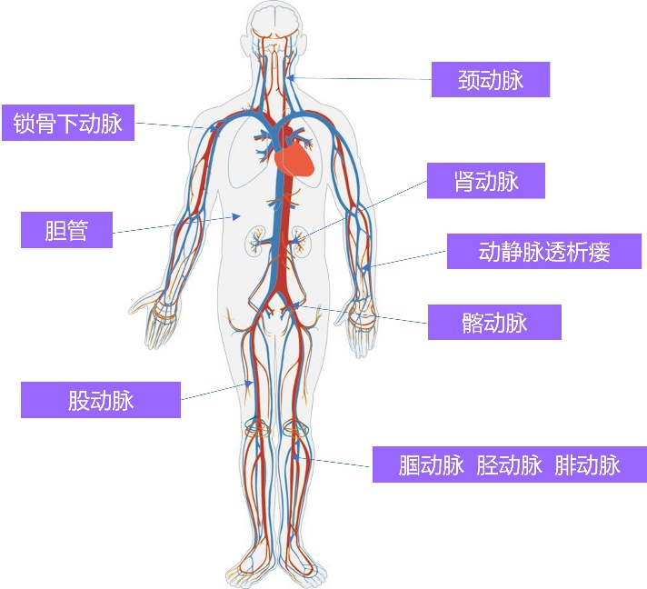 周游? Voyaging?球囊擴(kuò)張導(dǎo)管(圖3)